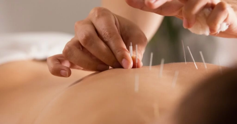 Acupuncture in Singapore: A Path to Healing and Wellness